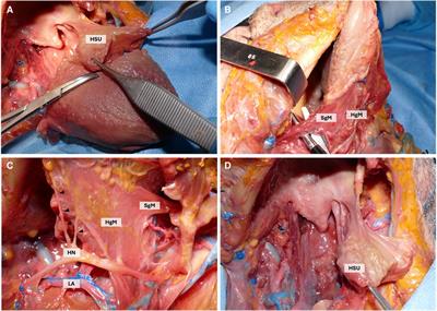 Subtotal glossectomy with conservation of the hyo-styloglossus unit (HSU): a new pivotal concept for preserving tongue function in extended glossectomy
